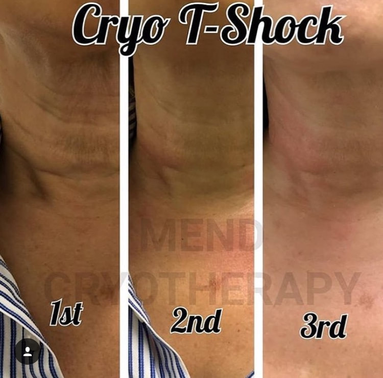 Does T-Shock Therapy Really Work? - Sculpt Tri-Cities
